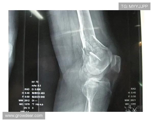 海港暴击加布伤退鼻骨折血流满